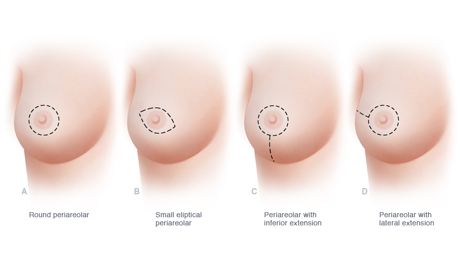 The various possible incisions used when a skin-sparing mastectomy is performed preserve most or all of the skin of the breast but allow for removal of the nipple and areola. Compared to traditional mastectomy, skin-sparing mastectomy, when combined with immediate breast reconstruction, minimizes scarring on the breast and helps optimize the cosmetic results of reconstruction. Several of the more commonly used incisions for skin-sparing mastectomy are illustrated.